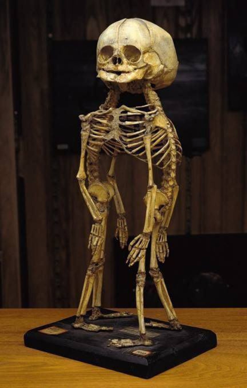 Скелет сіамських близнюків у музеї Мюттера